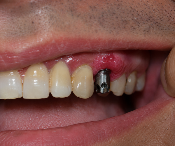 swollen gums after dental implants