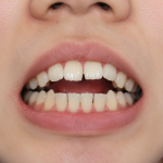 Open Bite