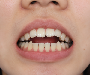 Open Bite