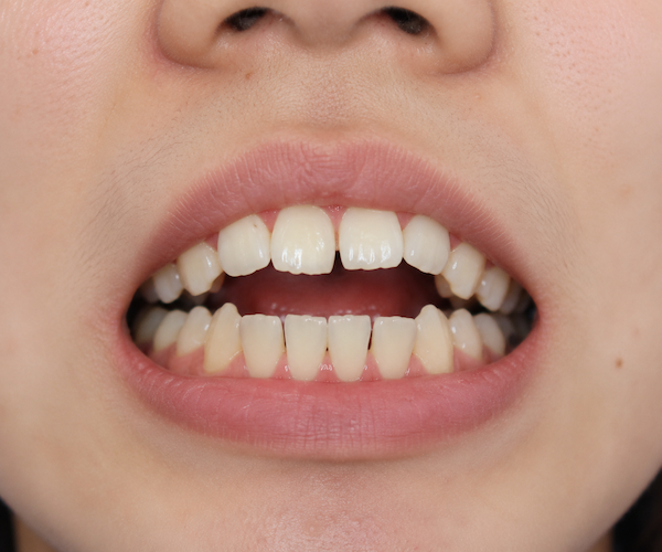 Open Bite