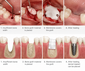 bone grafting for dental implants