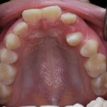 impacted tooth