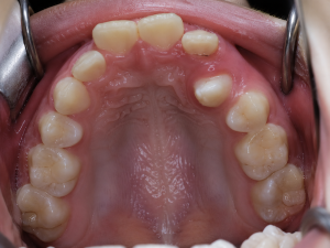 impacted tooth