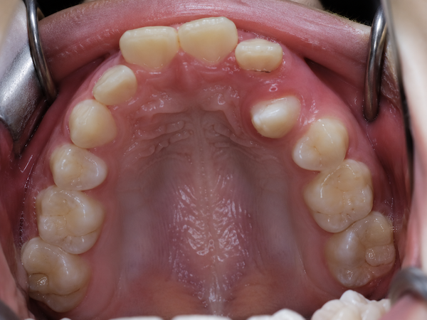 impacted tooth