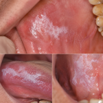 oral leukoplakia