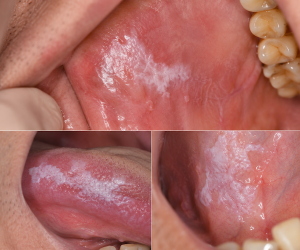 oral leukoplakia