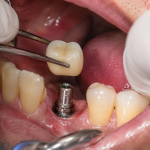dental implant loose