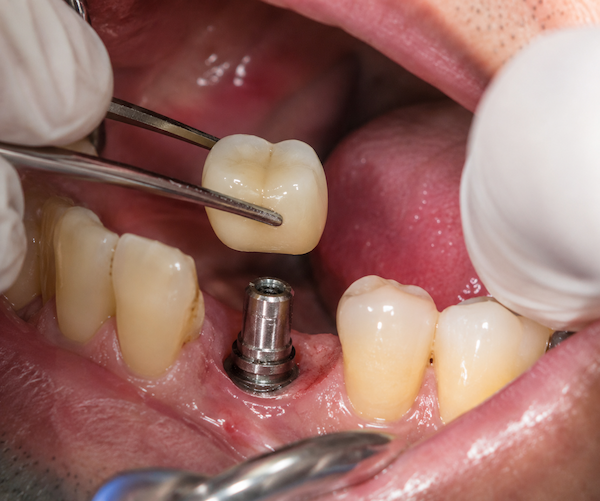 dental implant loose