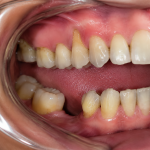 overeruption of opposing teeth