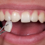 veneer for chipped tooth