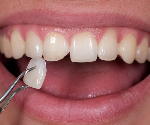 veneer for chipped tooth