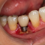 bad smell from dental implant