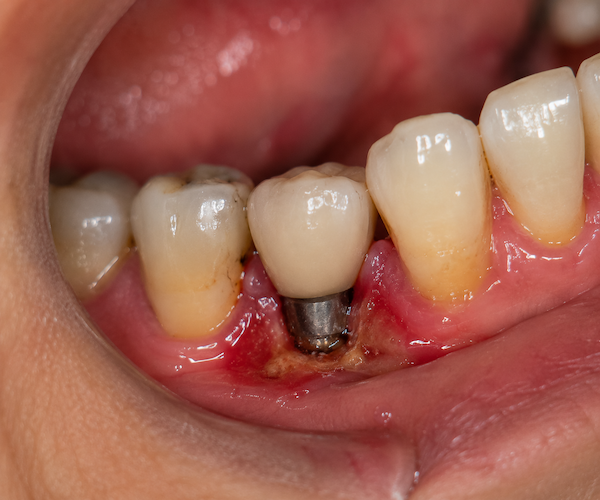 bad smell from dental implant