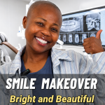 dental veneers in China