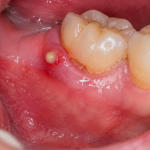 Recurrent Swollen Gums With Pus