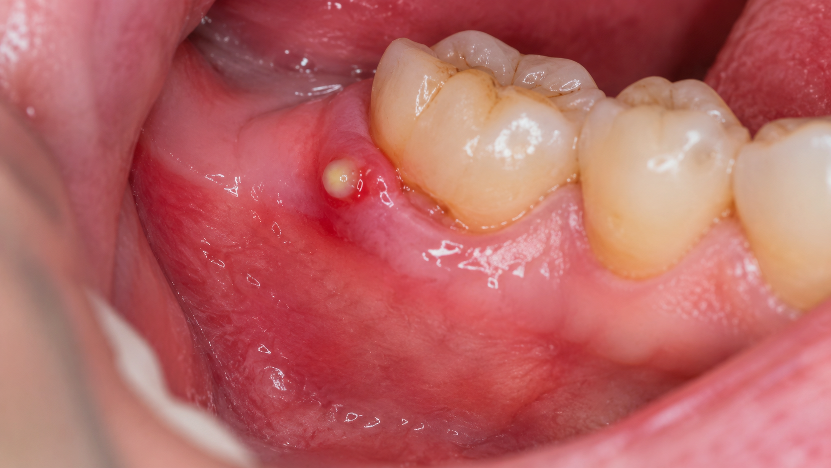 Recurrent Swollen Gums With Pus