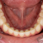 permanent retainer bottom teeth