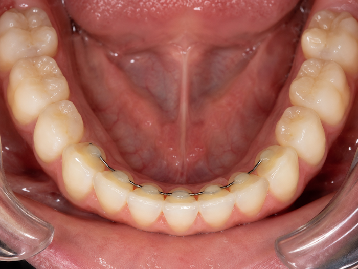 permanent retainer bottom teeth