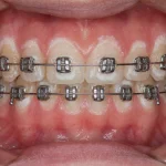 teeth demineralization