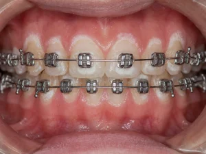 teeth demineralization