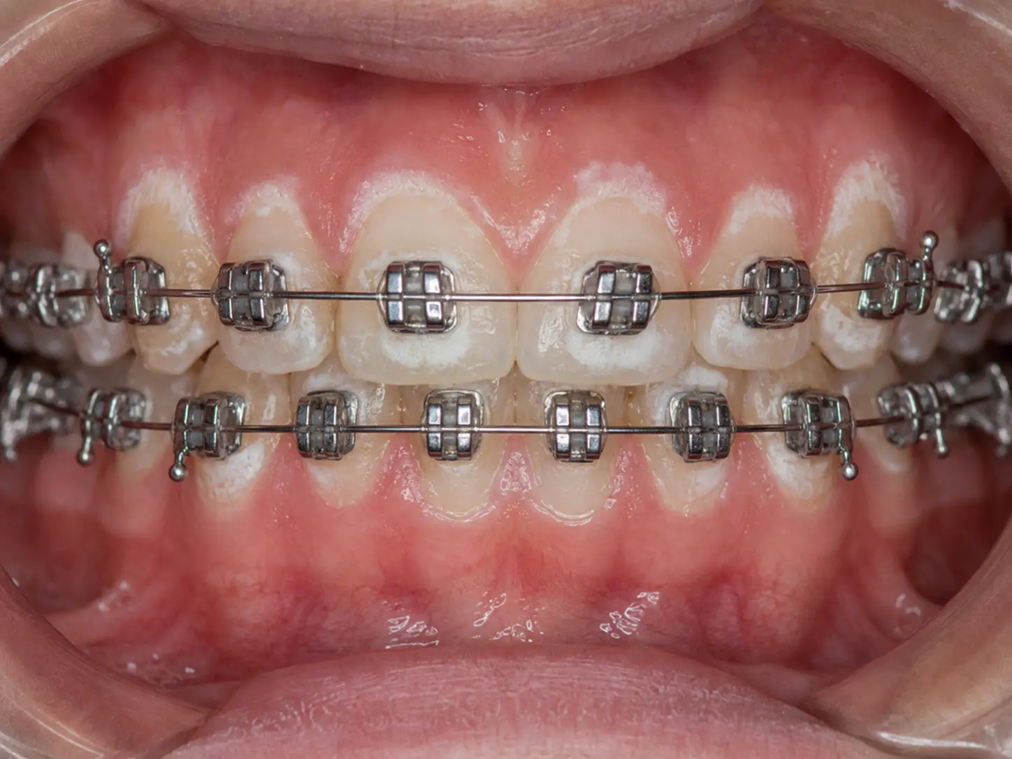 teeth demineralization