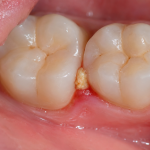 food impaction between teeth