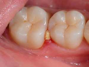 food impaction between teeth