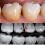 hidden tooth decay