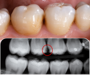 hidden tooth decay