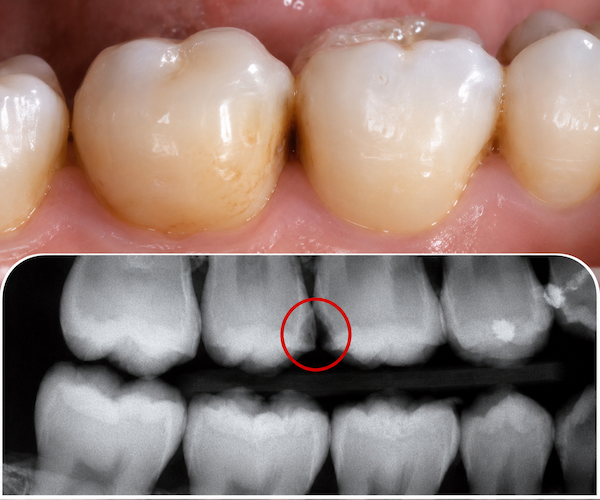 hidden tooth decay