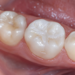 dental sealants