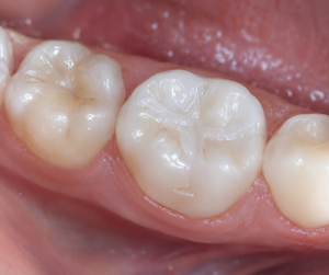 dental sealants