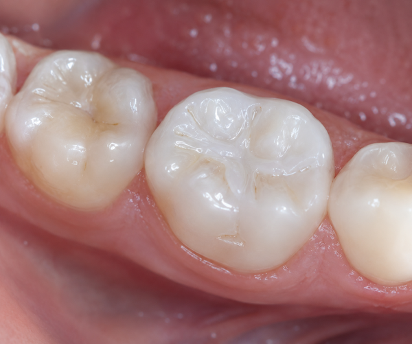 dental sealants