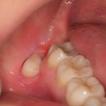 wisdom tooth pericoronitis symptoms