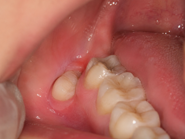 wisdom tooth pericoronitis symptoms