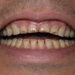 worn down teeth
