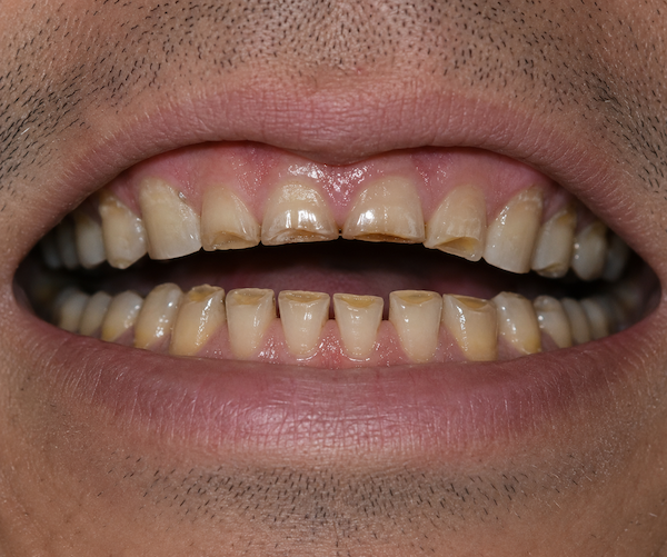 worn down teeth