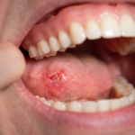 denture sores