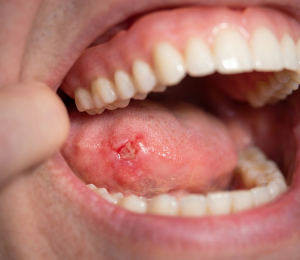 denture sores