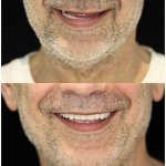 full mouth restoration China