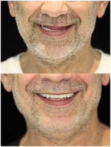full mouth restoration China