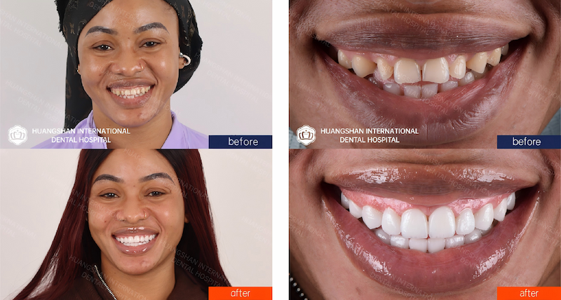 crooked teeth by veneers