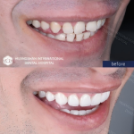 porcelain veneers china