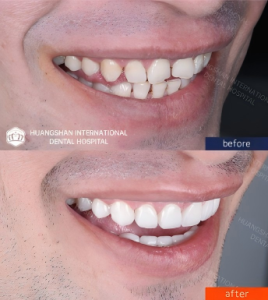 porcelain veneers china