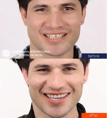 dental veneers case in huangshan dental clinic