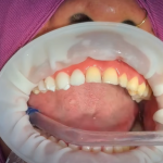 what do teeth look like under veneers