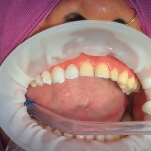 what do teeth look like under veneers