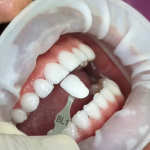 what do teeth look like under veneers