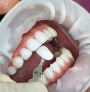 what do teeth look like under veneers