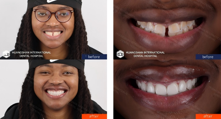 E-MAX veneers smile